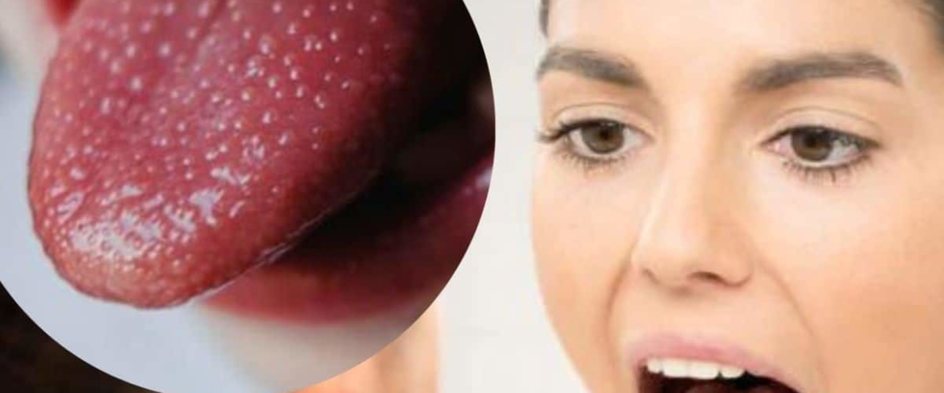The Surprising Connection Between Mouth Ulcers and Vitamin B12 Deficiency