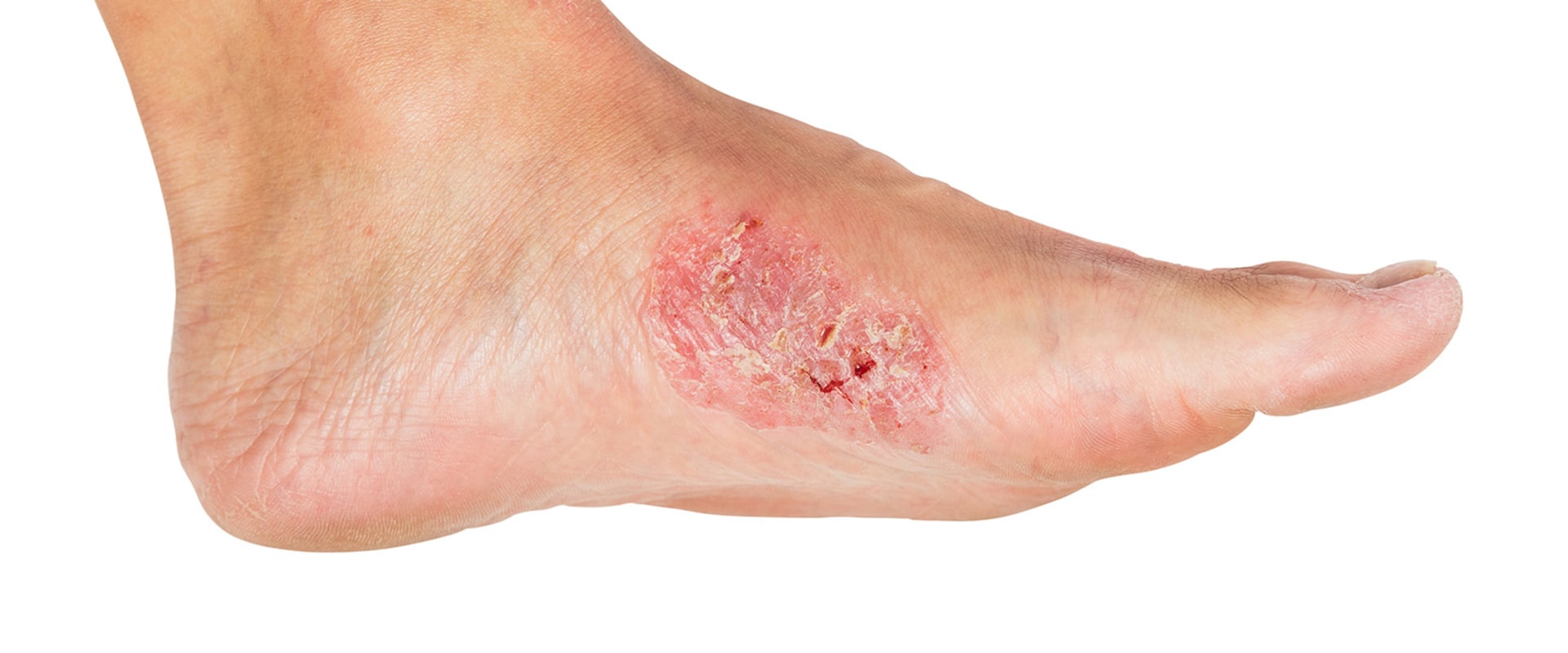 The Link Between Vitamin Deficiency and Skin Ulcers
