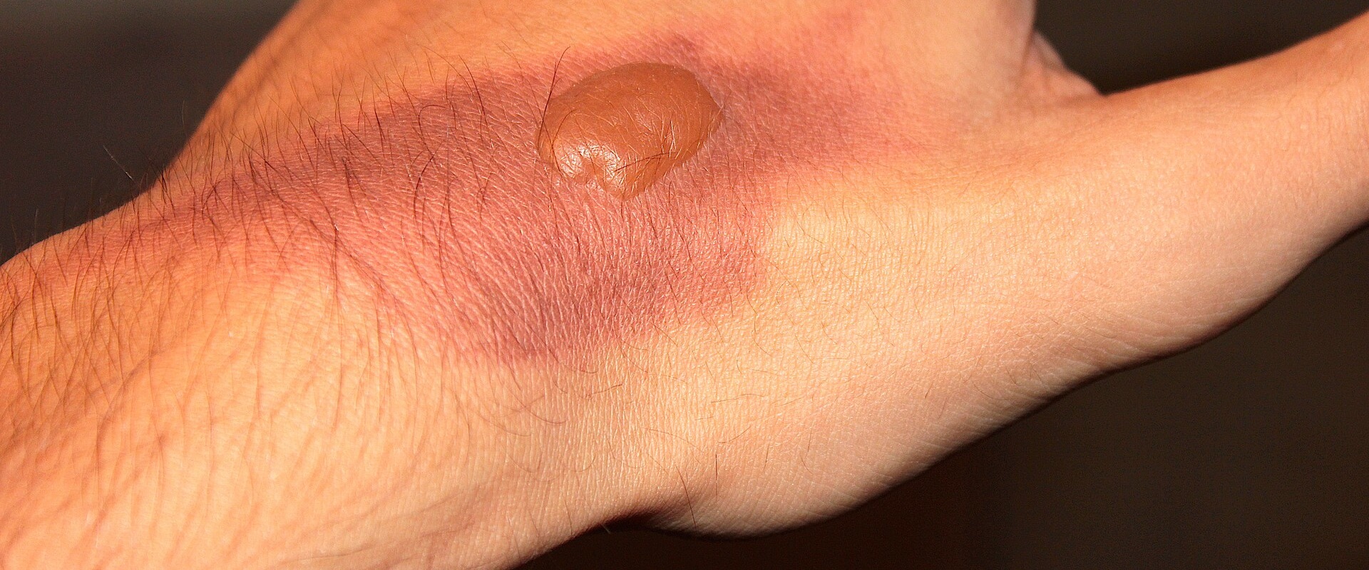 Essential Burn Degree Chart: Burn Types, Causes & First Aid Tips