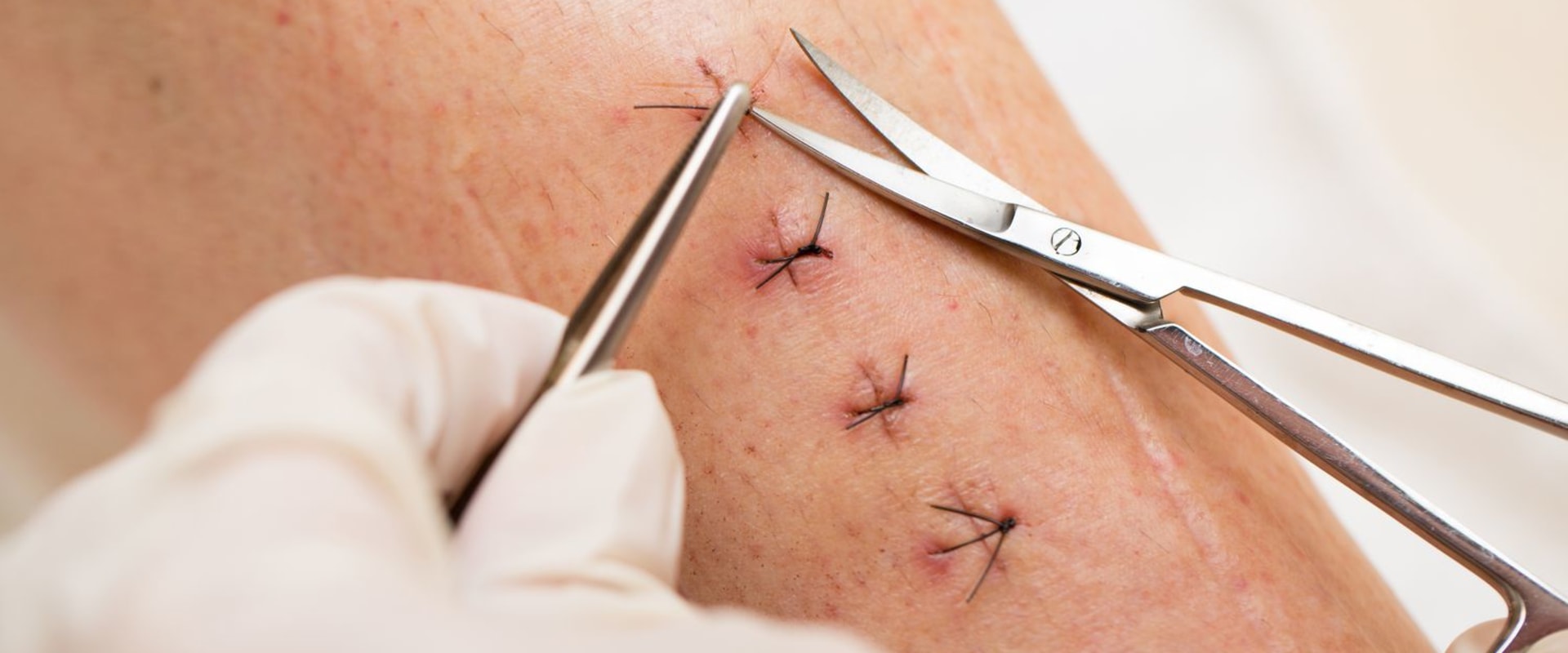 Do Stitches Hurt When Healing? Real Answers From Doctors and Patients