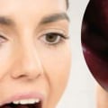 The Surprising Connection Between Mouth Ulcers and Vitamin B12 Deficiency