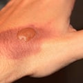Essential Burn Degree Chart: Burn Types, Causes & First Aid Tips
