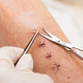 Do Stitches Hurt When Healing? Real Answers From Doctors and Patients