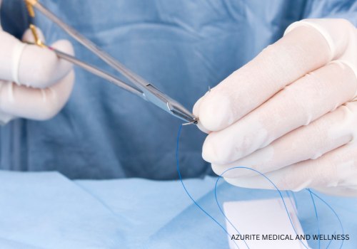 How Long Do Dissolvable Stitches Last? Complete Recovery Timeline