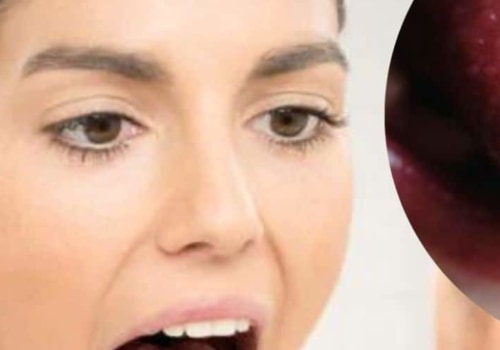 The Surprising Connection Between Mouth Ulcers and Vitamin B12 Deficiency