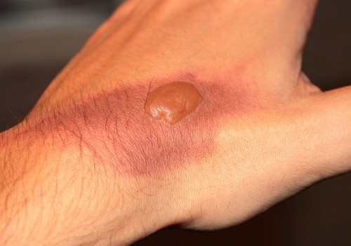 Essential Burn Degree Chart: Burn Types, Causes & First Aid Tips