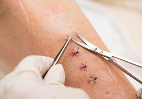 Do Stitches Hurt When Healing? Real Answers From Doctors and Patients